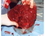 Mafia fetusilor gaseste Romania ideala pentru traficul cu extract de placenta. - Exista la DIICOT o sesizare recenta care afirma ca in Romania exista o retea a mafiei chinezesti care face trafic cu substante extrase din placenta si din embrioane umane, provenind de la institutiile medicale in care se fac avorturi, dar si de la maternitati. Legislatia romaneasca incrimineaza orice folosire a organelor, ori a embrioanelor in stare fetala, in domeniul cosmetico-farmaceutic, toate aceste "resturi" organice trebuind a fi inceinerate prin proceduri speciale.